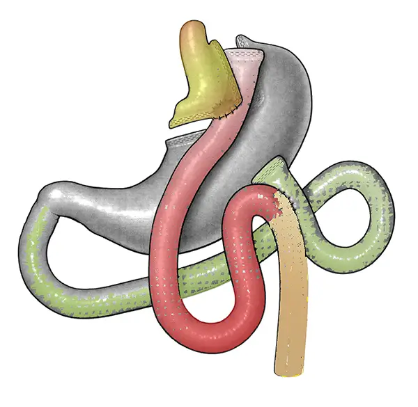 Bypass gastrico