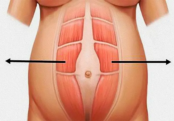 Diastasis de rectos-1