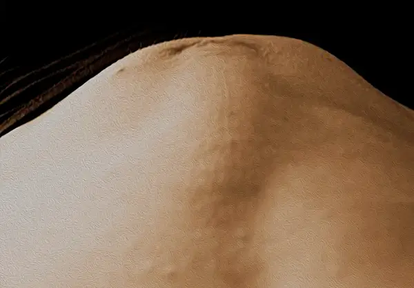Diastasis de rectos-2