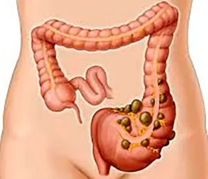 Enf Diverticular-1