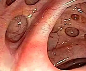 Enf Diverticular-2