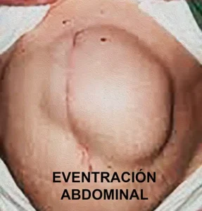 Eventracion Abdominal Eventracion Abdominal