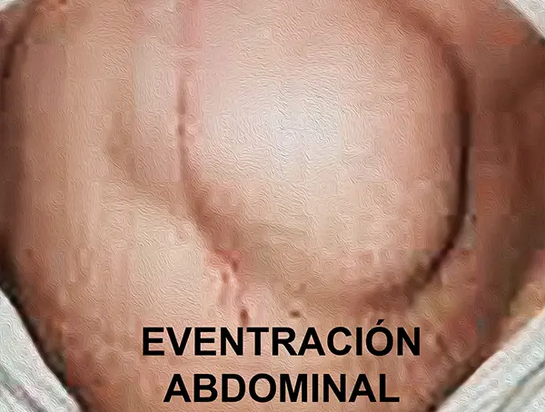 Eventracion Abdominal2