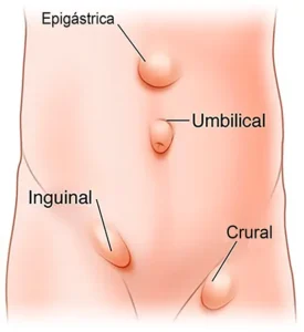 Hernioplastia-1