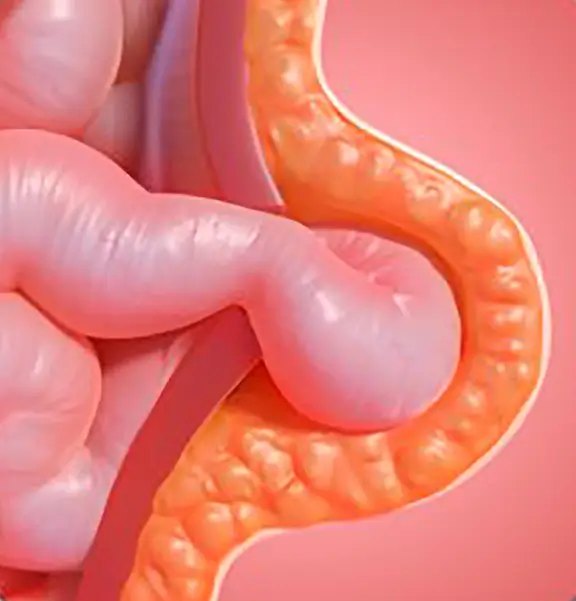 Hernioplastia